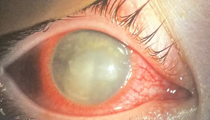 Close-up of the parasitic infection in Brooklyn McCasland's eye. Kennedy News and Media