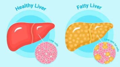 New Study Finds Strong Link Between Fatty Liver Disease and Gallstones