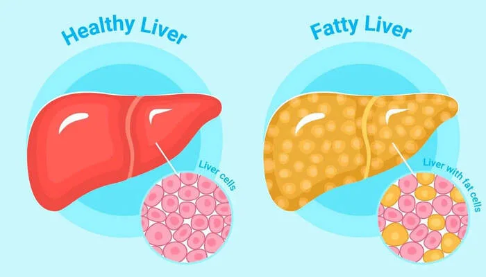 New Study Finds Strong Link Between Fatty Liver Disease and Gallstones