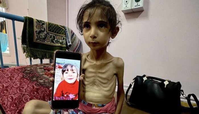 Gaza’s Smallest Victims Babies Face Starvation as Malnutrition Crisis Worsens
