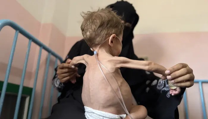 Why Malnutrition Is So Dangerous? Why It Causes Lasting Damage