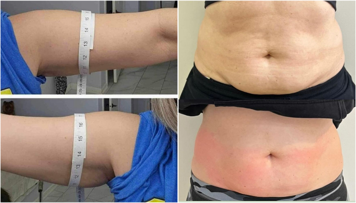 What Is Body Contouring? Procedures, Risks, Recovery, and Costs
